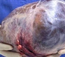 Tumor de 5 quilos é retirado do ovário de mulher em Juiz de Fora