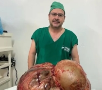Médicos retiram tumor de 46 KG de mulher no RJ